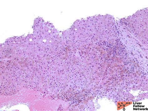 Pathology Pearls Hereditary Hemochromatosis Aasld