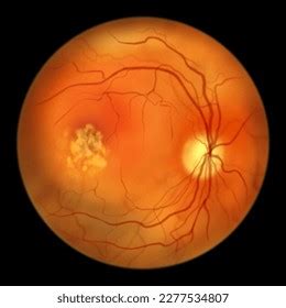 Best Disease Best Vitelliform Macular Dystrophy Stock Illustration ...