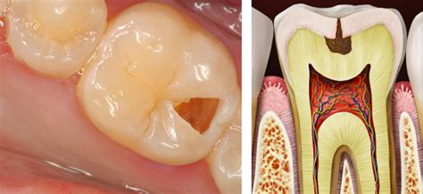 Understanding The 5 Stages Of Tooth Decay Treatment Small Bites