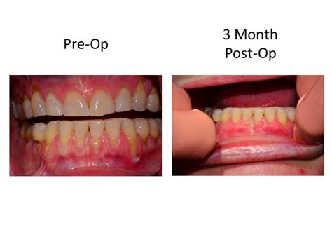 Dr Robert L Franklin Jr Pinhole Technique Pst Before And Afters