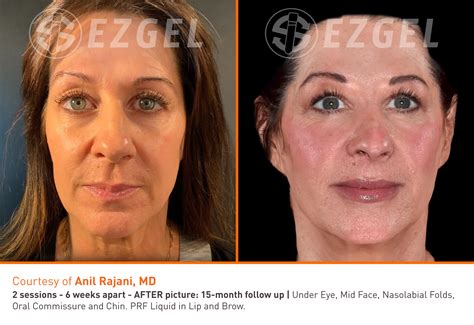 Ezgel Prf Benefits The Future Filler Of Natural Facial Rejuvenation