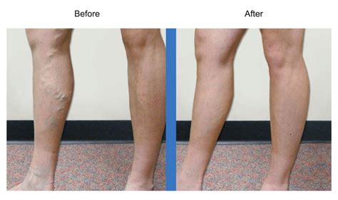 Before And After Photos Vein Specialists Of The Carolinas