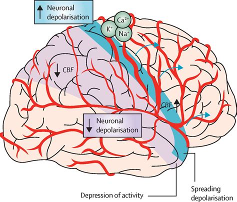 Headache Diagram