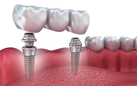 Pr Tesis Sobre Implantes Cl Nica Dental Larra Aga