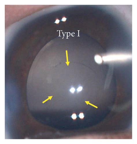 Ac Intraoperative Views For 3 Types Of Persistent Fetal Vasculature