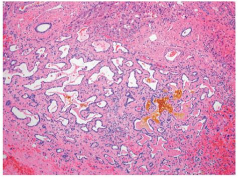 Benign And Malignant Biliary Tumors Basicmedical Key