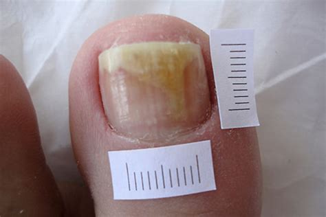 Traitement Des Mycoses Des Ongles Au Laser Paris Clinique