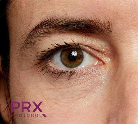 Prx Derm Perfexion Before And After Premier Plastic Surgery