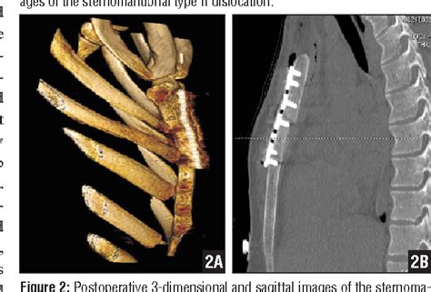 Figure 1 from Parallel plating for a sternomanubrial dislocation. | Semantic Scholar