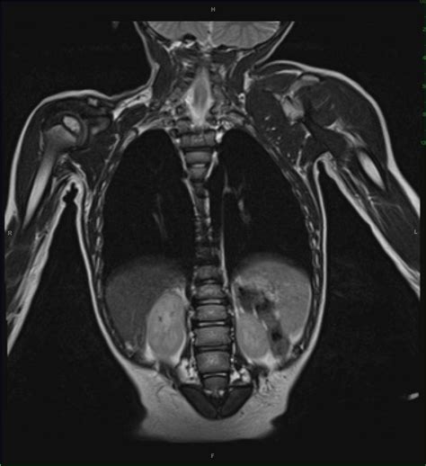 Caudal Regression Syndrome Mri