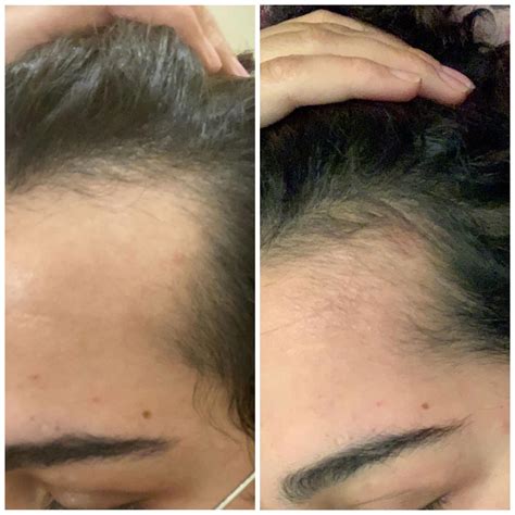 Minoxidil Results