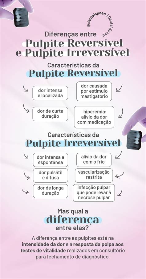 Pulpite Revers Vel E Pulpite Irrevers Vel Diferen A Entre As Doen As