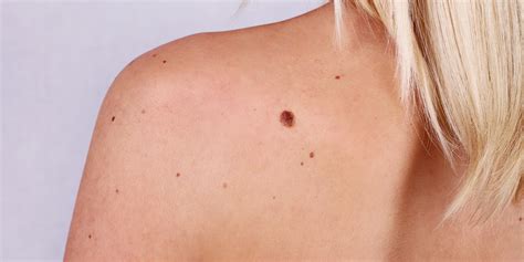 Majority Of Melanoma Skin Cancer Patients 'Do Not Have Irregular Moles', Study Suggests ...