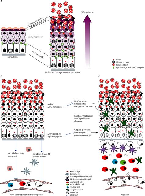 Molluscum Contagiosum Virus Infection The Lancet Infectious Diseases