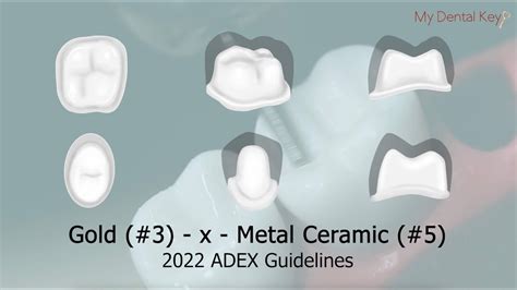 Pass The Cdca X Fixed Partial Denture Preparation My Dental Key