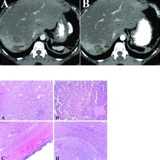 Contrast-enhanced CT scan image (Axial image). (A) Liver metastases ...