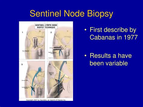 Ppt Surgery Of Penile And Urethral Carcinoma Powerpoint Presentation Id 3396308