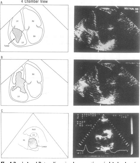 Figure 1 From Left Atrial Rhabdomyosarcoma Mimicking Mitral Valve