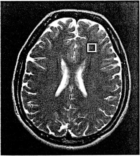 T2 Weighted MR Image Showing Representative VOI 1 5 X 1 5 X 1 5 Cm3