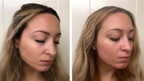 Laser Treatment On Acne Scars Before And Afters Tratament