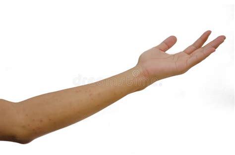 Rash In The Arm Stock Image Image Of Ache Derma Asia 107337815