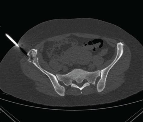 Ct Scan Of The Patients Pelvis Axial View Depicting The Ct Guided Download Scientific