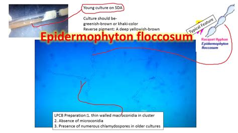Epidermophyton:General Characteristics, Pathogenesis, Clinical Findings