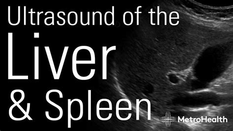 Ultrasound Of The Liver And Spleen Youtube