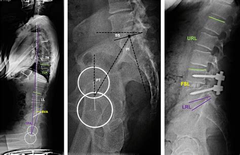 Measurements Of Spinopelvic Sagittal Parameters Download Scientific