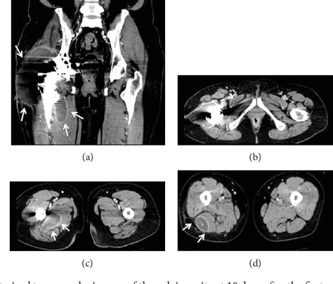 Figure 1 From Recurrent Hematomas Following A Revision Total Hip Arthroplasty In Acquired