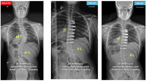 Scoliosis Surgery Before and After