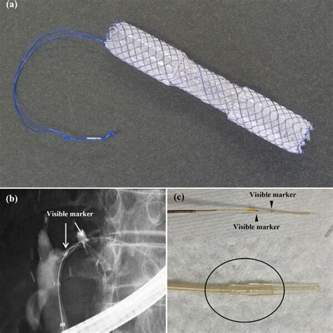 A Intraductal Fully Covered Selfexpandable Metallic Stent BONASTENT