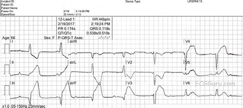 Inferior Wall Mi With Wide Qrs And Complete Av Block Ecg Guru Instructor Resources