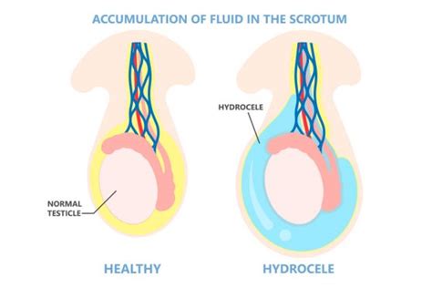 Scrotal Surgery Sydney Dr Haddad