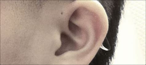 Do You Know Why Some People Are Born With Tiny Holes Above Their Ears Ary News