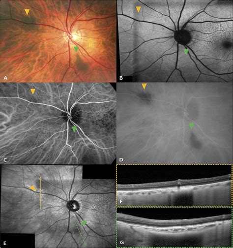 Posterior Scleral Melanocytosis A Novel Fundus Finding Masq Retinal Cases And Brief Reports