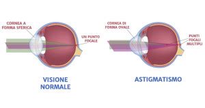 Astigmatismo Semplice Composto Misto Sintomi Cause E Cura