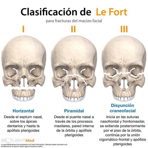 Classifica O De Le Fort