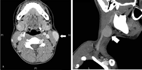 Ct Scan Of The Neck Revealing A Focal Dilatation Of The Left External