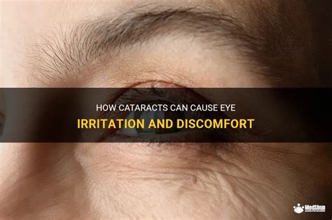 How Cataracts Can Cause Eye Irritation And Discomfort Medshun