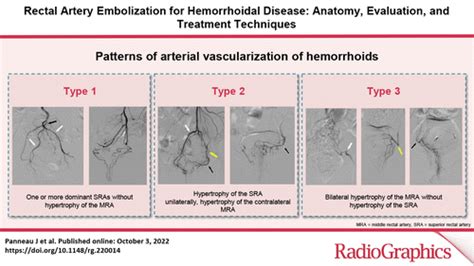 Rectal Artery Embolization For Hemorrhoidal Disease Anatomy