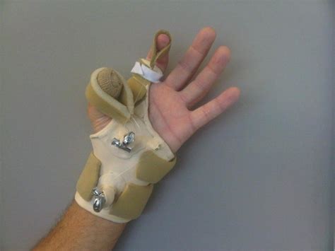 Dynamic Thumb Flexion Splint