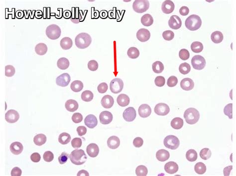 Blood Morphology Ask Hematologist Understand Hematology