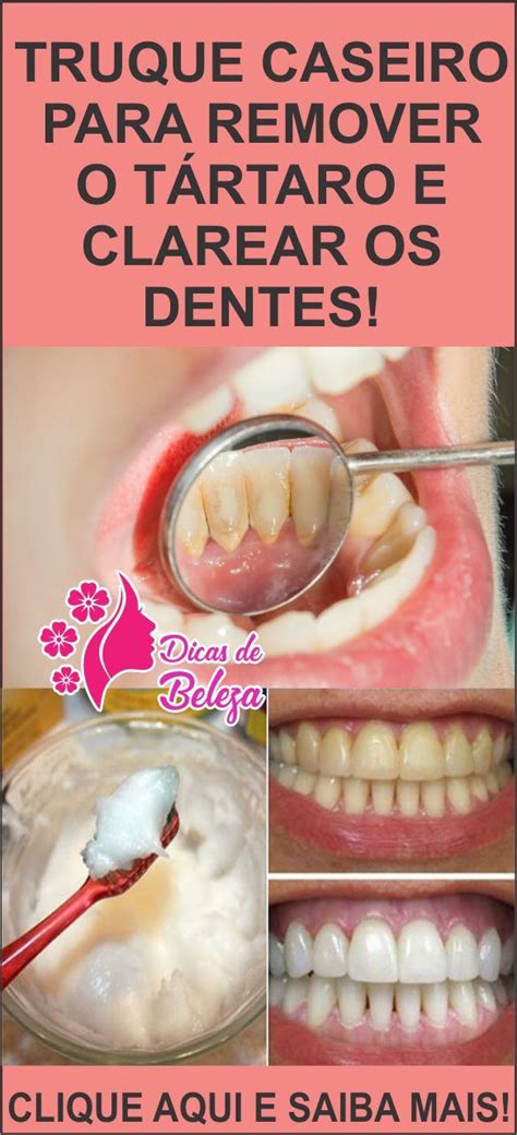 Truque Caseiro Para Remover O T Rtaro E Clarear Os Dentes Dental