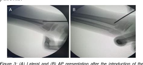 Distal Radius Fracture Kapandji Intrafocal Pinning Technique