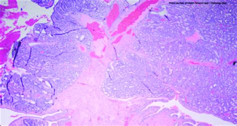 Final Pathology Revealed A T A Gallbladder Intramucosal Adenocarcinoma