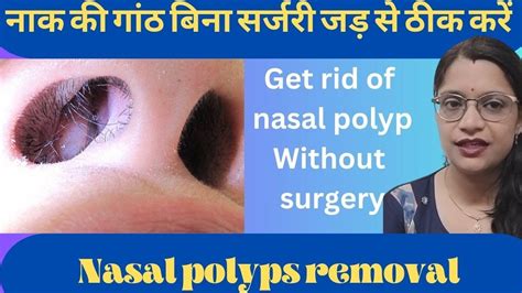 Nasal Polyps Risk Factor Symptoms Homeopathic Formula नाक के बढ़े मांस