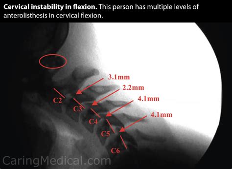 Cervical Dysstructure Cervicovagopathy