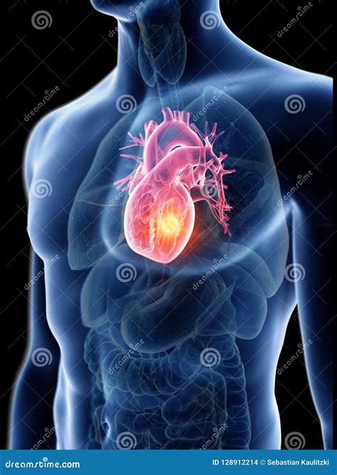 A mans heart tumor stock illustration. Illustration of aortic - 128912214