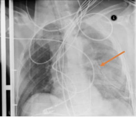 Chest Tube Complications and How to Fix Them - County EM - Trauma